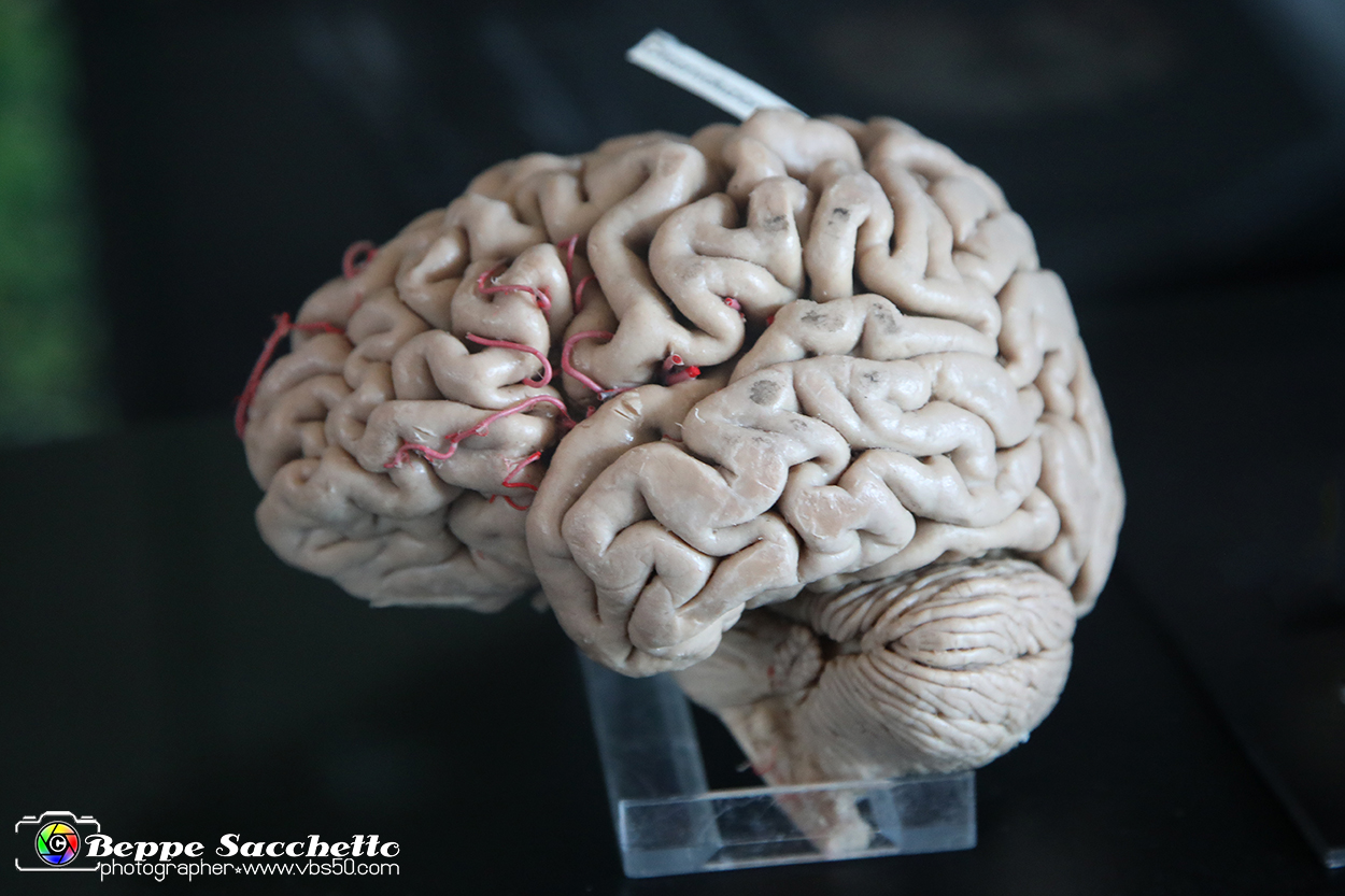 VBS_2950 - Cervello. Morbo di Alzheimer - Mostra Body Worlds.jpg